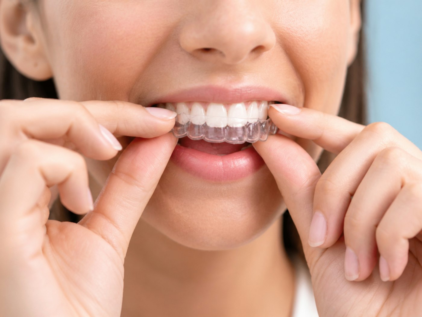 Invisalign®